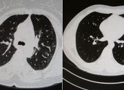 Covid’e yakalanan 2 gencin tomografisi